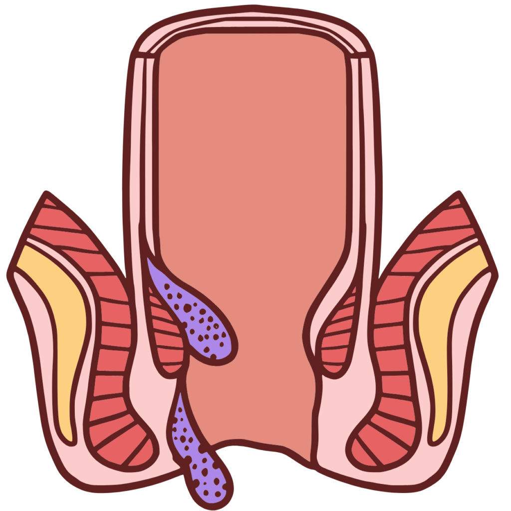 Hemorrhoidectomy (Piles Surgery)