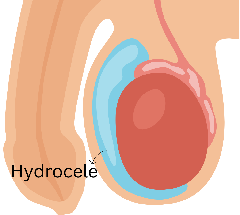 hydrocele