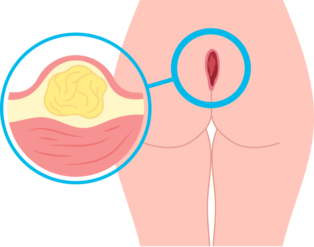 pilonidal