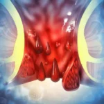 Piles (Hemorrhoids)